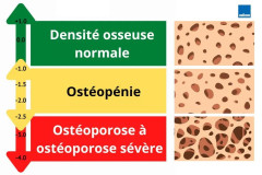 Ostéoporose, comment faire de vieux os ?, févr. 2024