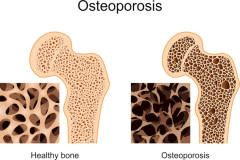 Ostéoporose, structure des os, juin 2024