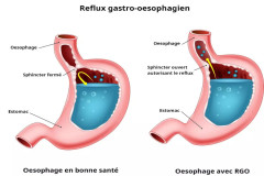 Le reflux gastro-œsophagien, août 2024