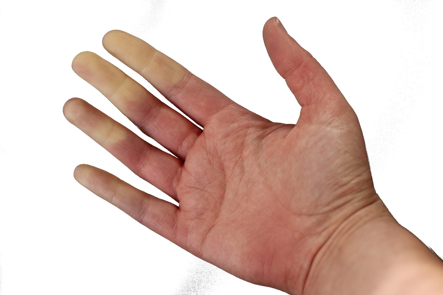 maladie-de-raynaud.jpg, nov. 2023